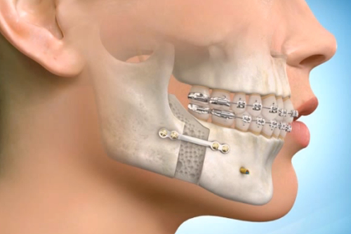 Jaw Surgeon Dallas