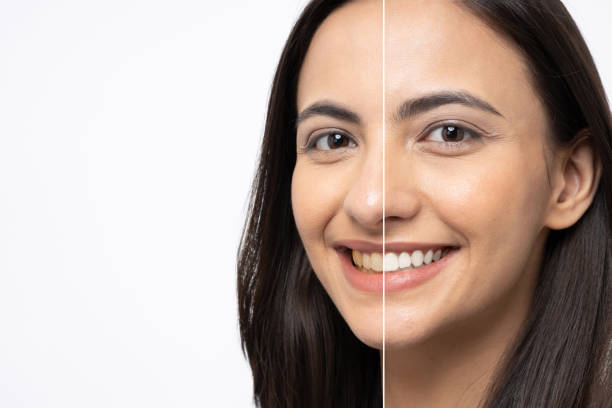 teeth whitening Perth